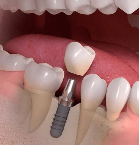 How Implant Dentists Restore Smiles After Trauma Or Tooth Loss