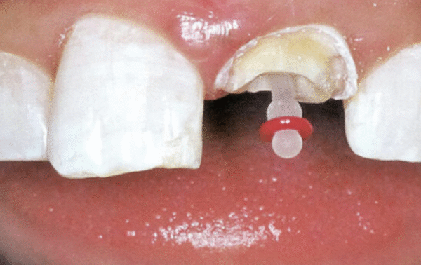 4 Design Features That Help A Dental Restoration Stay Easier To Clean