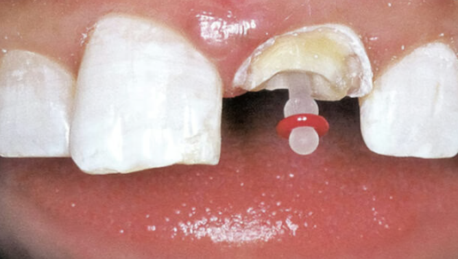 4 Design Features That Help A Dental Restoration Stay Easier To Clean