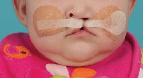 The Importance Of Oral Surgeons In Treating Cleft Lip And Palate